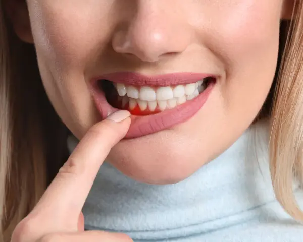 Wyrwanie zęba: Gojenie dziąsła krok po kroku. Uniknij suchego zębodołu!