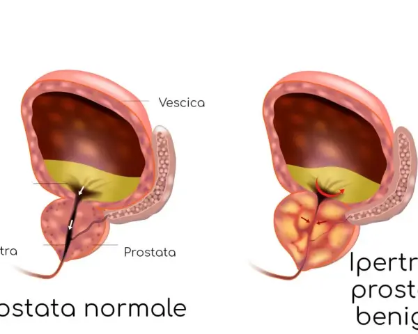 Confronto tra prostata normale e prostata infiammata, dove l'ipertrofia prostatica benigna comprime l'uretra, ostacolando il flusso urinario.