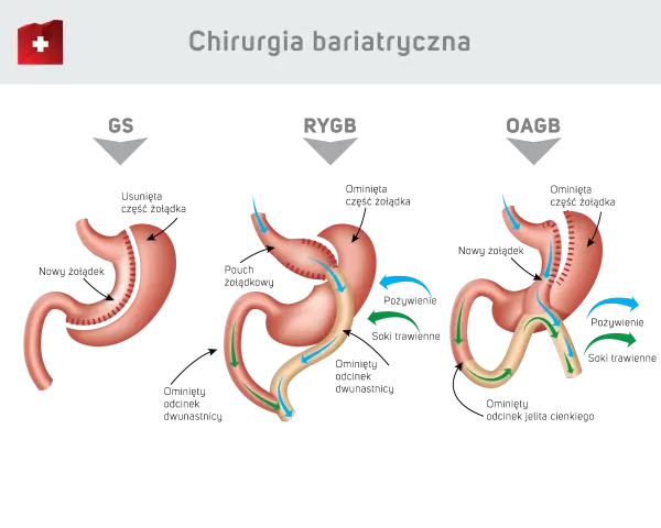 Ilustracja porównuje trzy typy operacji bariatrycznych: GS, RYGB, OAGB. Dowiedz się, ile kosztuje operacja bariatryczna i jakie są jej rodzaje.