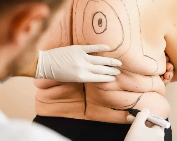 Liposukcja: Co to jest? Zrozum zabieg modelowania sylwetki