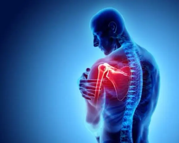 Anatomie d'un homme montrant une douleur vive à l'arrière de l'épaule, mise en évidence par une zone rouge intense.