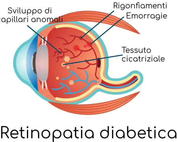 Illustrazione della retinopatia diabetica: sviluppo di capillari anomali, rigonfiamenti, emorragie retiniche che si riassorbono e tessuto cicatriziale.