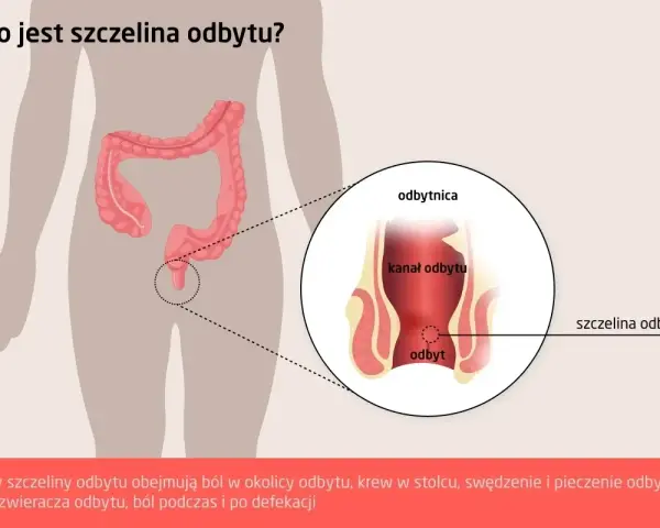 Ilustracja medyczna przedstawiająca szczelinę odbytu. Widoczny jest fragment jelita grubego i odbytnicy z zaznaczoną szczeliną.