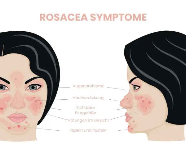 Rosacea-Symptome: Rötungen, sichtbare Blutgefäße, Papeln. Warum kein Hyaluron bei Rosacea? Die Haut ist empfindlich und braucht sanfte Pflege.