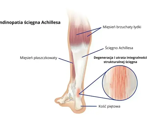 Anatomia podudzia człowieka z zaznaczonym ścięgnem Achillesa, mięśniami i kością piętową. Widoczna degeneracja ścięgna.