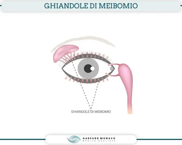 Illustrazione anatomica dell'occhio che evidenzia le ghiandole di Meibomio infiammate, responsabili della produzione del film lacrimale.