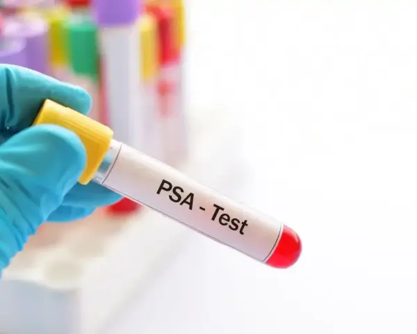 Rękawiczka trzyma probówkę z napisem "PSA - Test". To badanie psa, które pozwala ocenić jego stan zdrowia.
