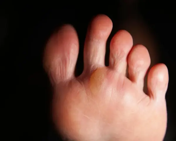 Gros plan sur un pied, montrant une phlyctène jaune entre deux orteils, signe d'une irritation due à la marche.
