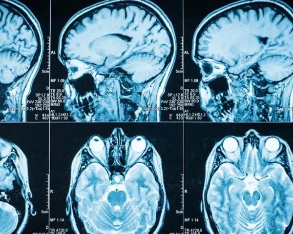 Guz mózgu objawy psychiczne: jak rozpoznać niebezpieczne sygnały