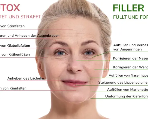 Gesicht einer Frau mit markierten Bereichen für Botox und Filler zur Behandlung von falten im gesicht, Stirnfalten, Krähenfüßen und Marionettenfalten.