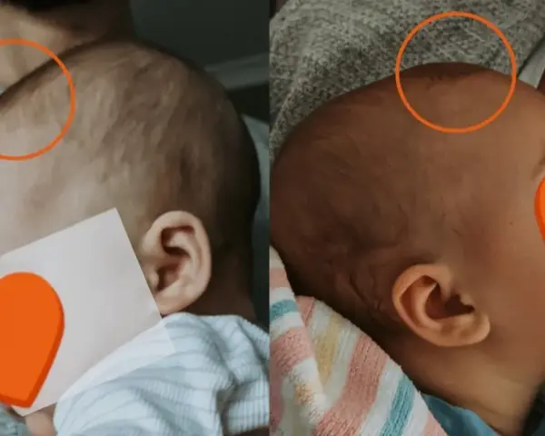 Dwa ujęcia główki niemowlaka, na których widoczny szew czołowy.