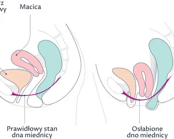 Prawidłowy stan dna miednicy vs. osłabione dno miednicy. Widoczna macica w tyłozgięciu, pęcherz i pochwa.