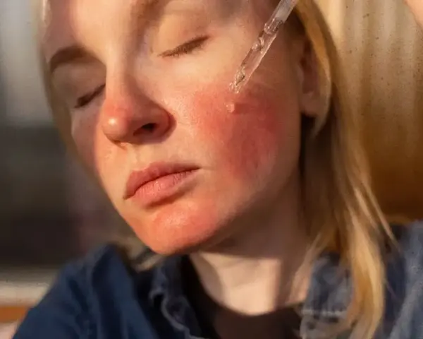 Czerwona, podrażniona skóra twarzy po aplikacji serum. Możliwe niacynamid skutki uboczne.