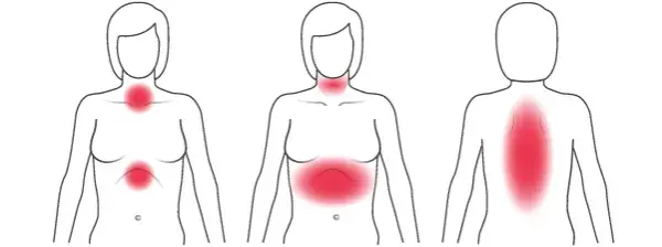Herzinfarkt Frauen Symptome: Unterschätzte Anzeichen rechtzeitig erkennen