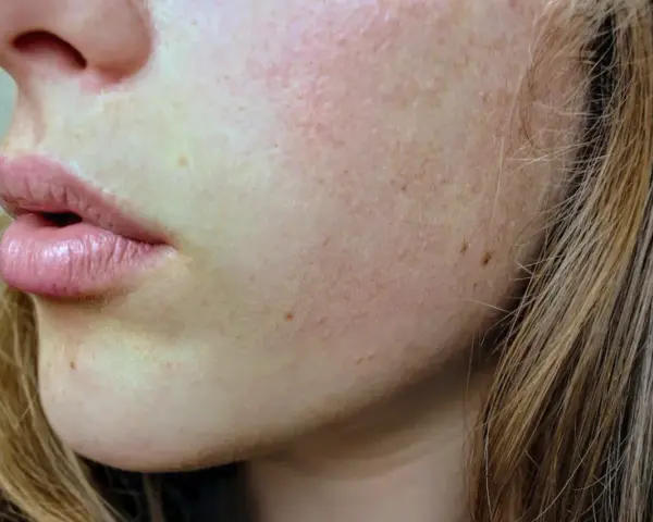 Primer plano de la piel de una mujer con poros obstruidos, pecas y labios rosados.