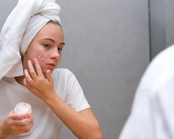 Mädchen mit Handtuch auf dem Kopf trägt Zinksalbe auf Pickel im Gesicht auf.
