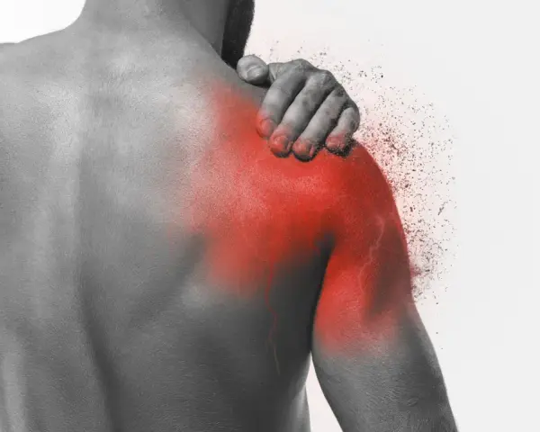 Ból barku, objaw capsulitis adhesiva, zaznaczony czerwienią.