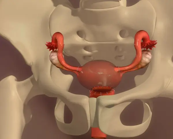Anatomical model showing the female reproductive system within the pelvis. The uterus has undergone usunięcie macicy, with sutures visible at the cervical stump.