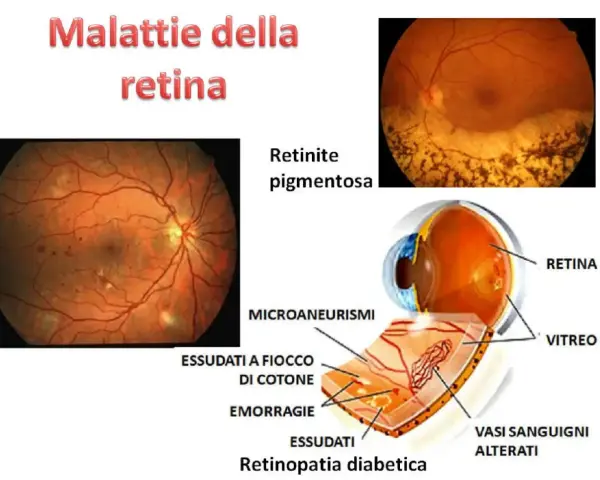 Immagini di malattie retiniche, tra cui la retinite pigmentosa e la retinopatia diabetica, che mostrano difetti dell'epitelio pigmentato retinico, emorragie e vasi sanguigni alterati.