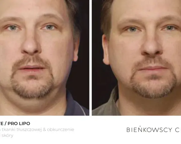 Przed i po zabiegu lipolizy podbródka. Widoczna redukcja tkanki tłuszczowej i poprawa napięcia skóry.