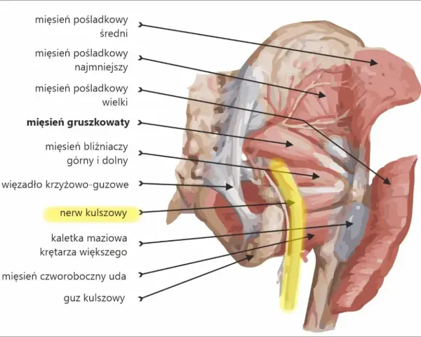 Anatomia miednicy: wbicie igły w nerw kulszowy, przebiegający obok mięśnia gruszkowatego.