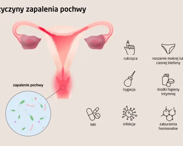 Infekcja pochwy: Badanie moczu nie wystarczy. Co robić?