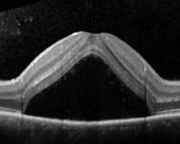 OCT di occhio con corioretinopatia sierosa centrale. Evitare stress e cortisone per non peggiorare la condizione.