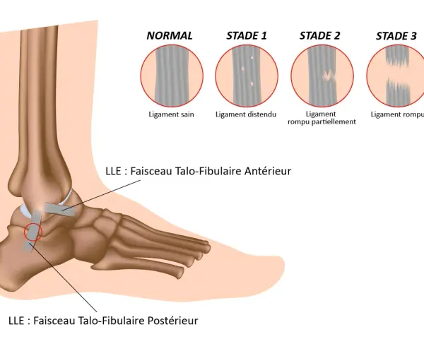 Illustration des différents stades d'une entorse du pied, du ligament sain au ligament rompu.