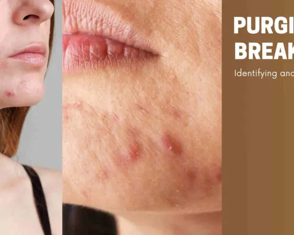 Close-up of a face with acne, showing breakouts after starting a new skincare routine. Text reads "PURGING VS. BREAKOUTS: Identifying and Managing Your Skin's Response.