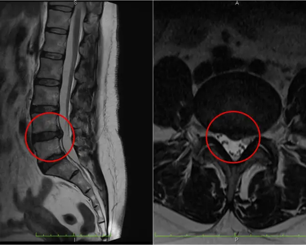 Obraz MRI kręgosłupa lędźwiowego z widoczną protruzją krążka międzykręgowego, zaznaczoną na czerwono.