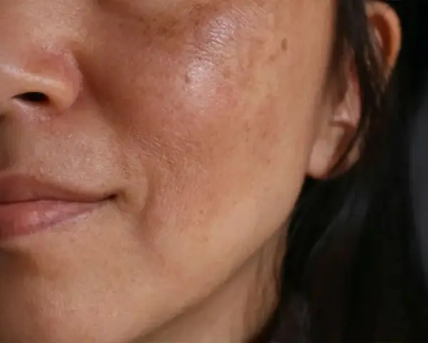 Primo piano del viso di una donna con evidenti macchie solari e discromie sulla pelle.