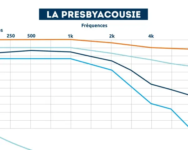 Graphique montrant la perte auditive en décibels selon l'âge et la fréquence. À partir de 20 dB, on entend moins bien.