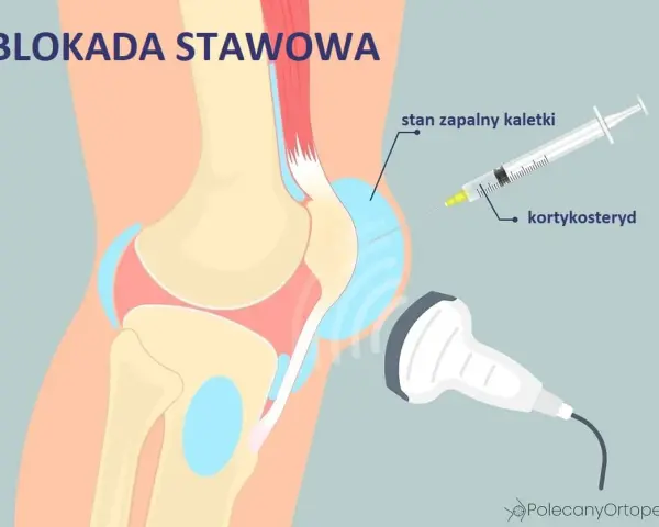 Ilustracja przedstawia blokadę stawową kolana. Zastrzyki w kolano z kortykosteroidem pod kontrolą USG pomagają przy stanie zapalnym kaletki.