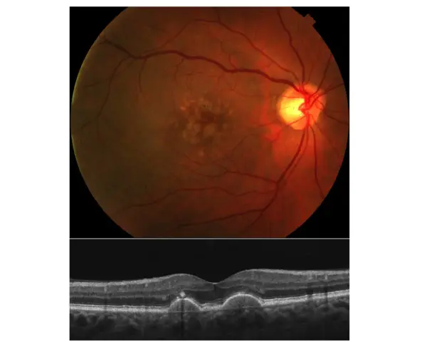 Immagine OCT e fondo oculare che mostrano segni di degenerazione maculare, il cui significato è cruciale per la diagnosi.