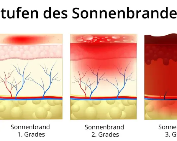 Illustrationen zeigen Hautschichten bei Sonnenbrand 1., 2. und 3. Grades. Der Sonnenbrand 2. Grades zeigt Blasenbildung in der Epidermis und Rötung der Dermis.