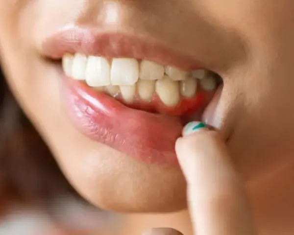 Czy antybiotyk pomoże na ból zęba? Prawda o leczeniu bólu zęba