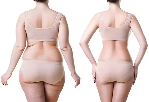 Liposukcja: Ile kg tłuszczu usuniesz? Modeluj, nie odchudzaj!