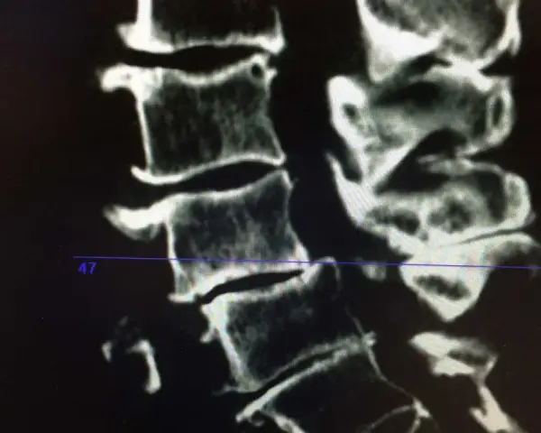 Radiographie montrant l'arthrose cervicale d'un cheval, avec des signes de dégénérescence osseuse au niveau des vertèbres.