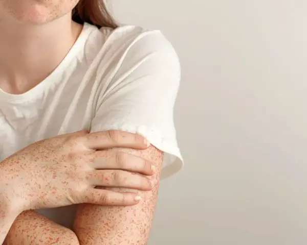 Alergia na nikiel w jamie ustnej 19% dorosłych cierpi. Poznaj objawy i leczenie