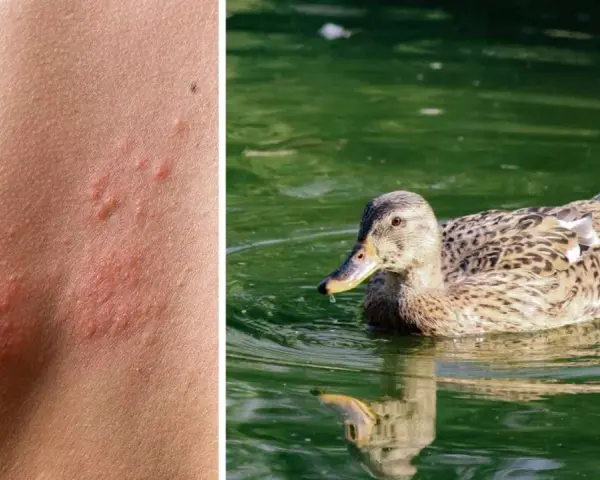 Haut mit roten Pusteln, die auf einen Zerkarien Ausschlag hindeuten, neben einer Ente im Wasser.