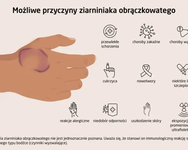 Dłoń z widocznym ziarniniakiem obrączkowatym. Obok ikony symbolizujące możliwe przyczyny: choroby, cukrzyca, nowotwory, leki, alergie, uszkodzenia skóry, promieniowanie UV.