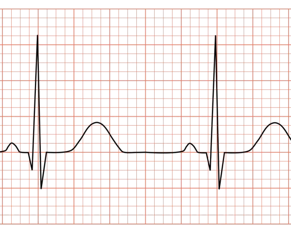 En EKG-kurva visas på ett rutnät. Denna hrv tabell visar hjärtats rytm.