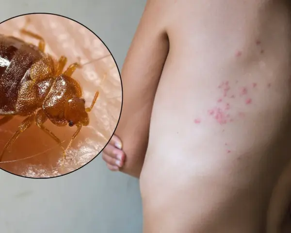 Primer plano de una chinche sobre piel humana, con erupciones rojas visibles en la espalda, indicando picaduras de chinches en el cuerpo.