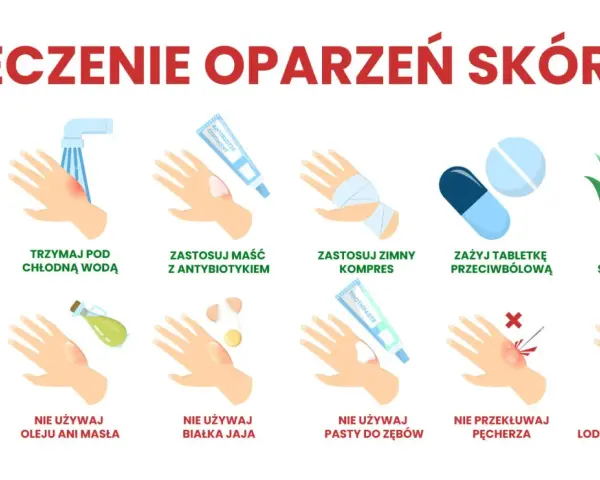 Co na oparzenie wrzątkiem domowe sposoby: chłodna woda, maść z antybiotykiem, zimny kompres, aloes. Unikaj masła, jajka, pasty do zębów, lodu.