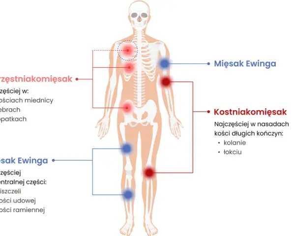 Schemat przedstawia lokalizację mięsaków: chrzęstniakomięsaka w miednicy, żebrach i łopatkach, a mięsaka Ewinga w piszczeli, kości udowej i ramiennej.