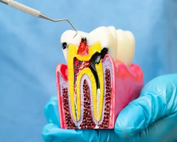 Model zęba z widocznym ubytkiem i narzędziem dentystycznym. Zastanawiasz się nad leczeniem kanałowym? Cena może być niższa niż myślisz.