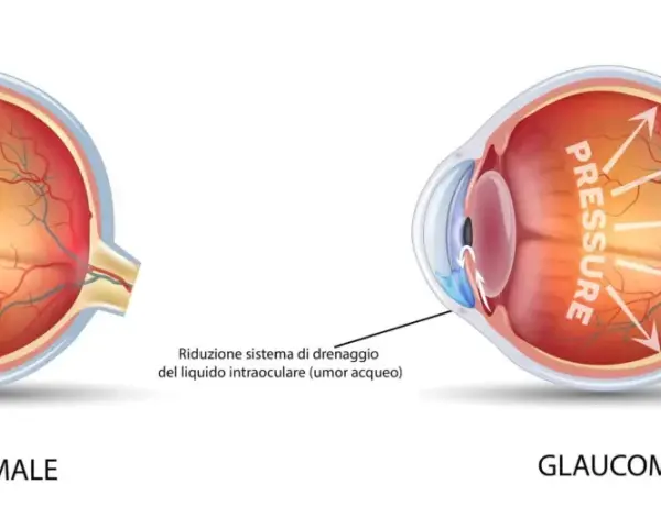 Confronto tra occhio normale e occhio con glaucoma. L'immagine mostra come la pressione elevata nel glaucoma danneggi il nervo ottico.