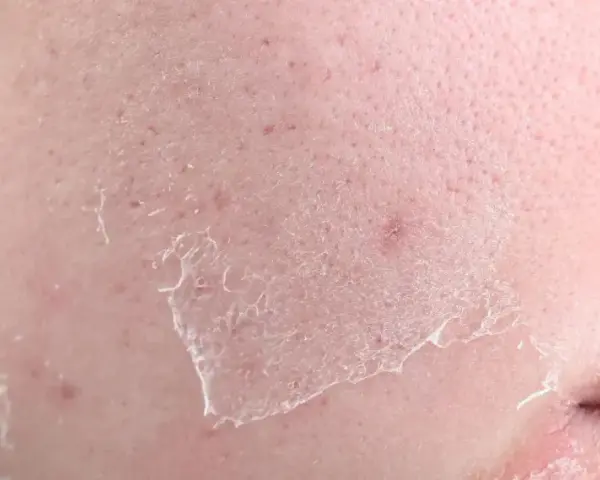 Close-up of dry, flaky skin with peeling patches, indicating what causes transepidermal water loss.