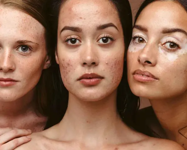 Drei Frauen mit unterschiedlichen Hauttypen: Sommersprossen, Akne und Vitiligo. Jede Haut verdient die passende mischhaut pflege.