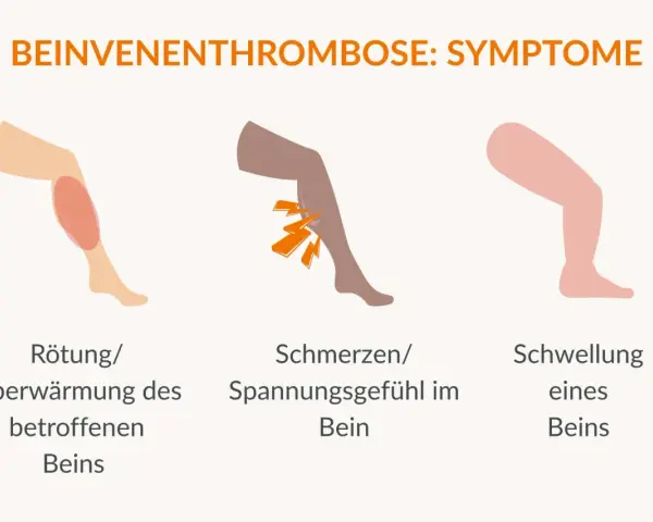 Rötung, Schmerzen und Schwellung am Bein sind Symptome, die auf eine Thrombose hinweisen können. Achte auf diese Anzeichen!